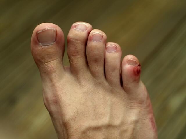 https://upload.wikimedia.org/wikipedia/en/d/dc/Stubbed_toe.JPG