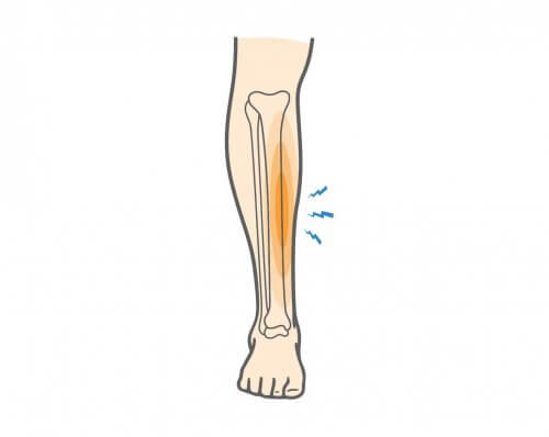 Shin-Splints symptoms