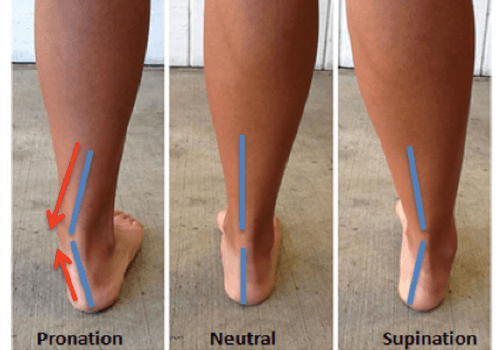 overpronation