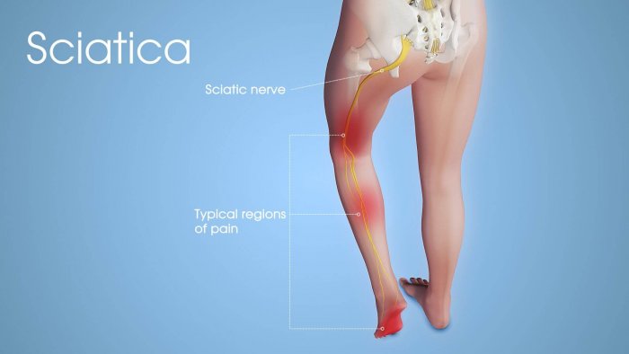 sciatica pain