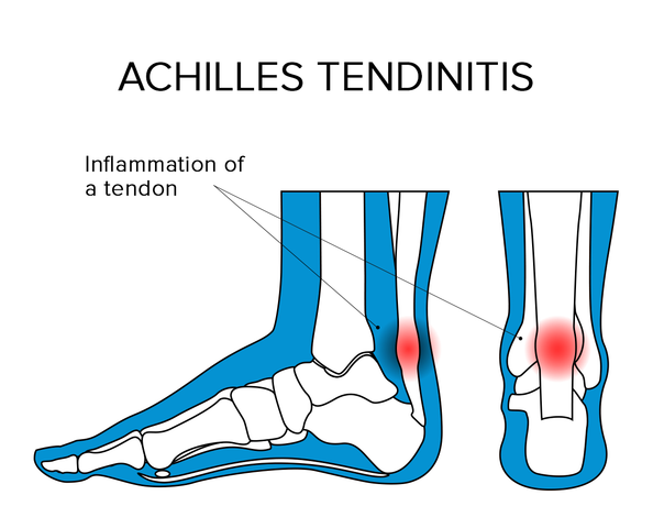 Achilles Tendinitis