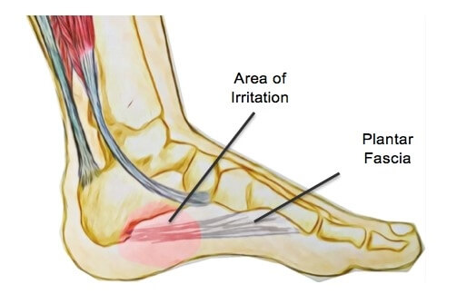 Plantar-Fasciitis and zero drop shoes