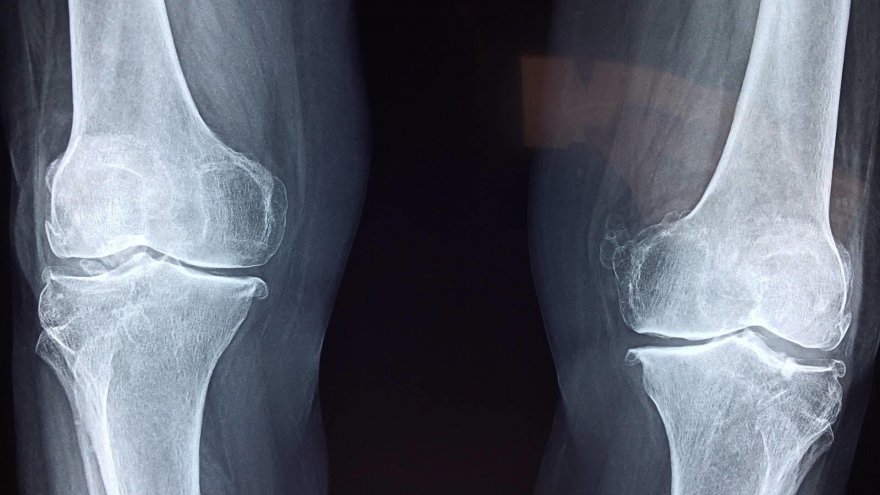 Running After Total Joint Replacement