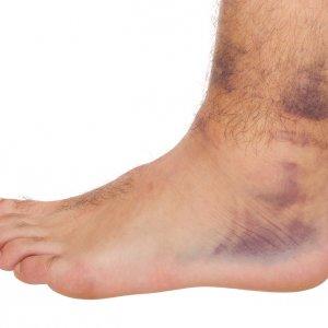 Trail-Running-hazards-Ankle-Sprain