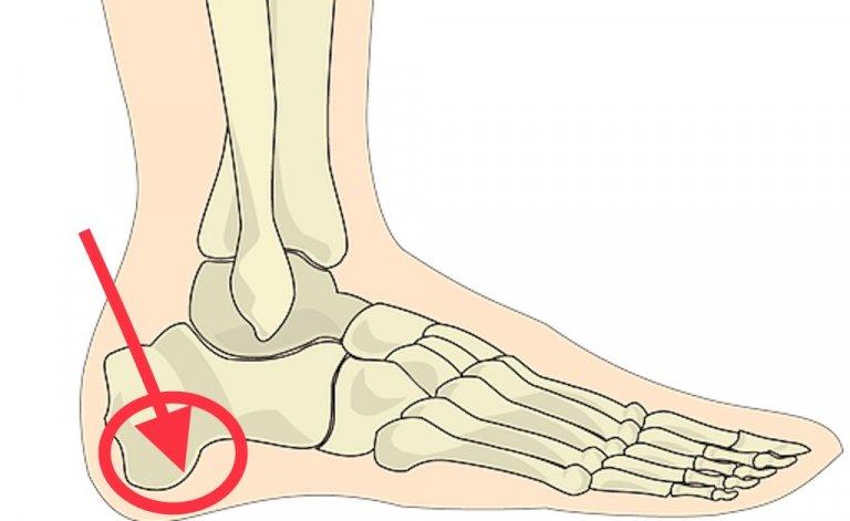 What You Need to Know About Heel Spurs | RunnerClick
