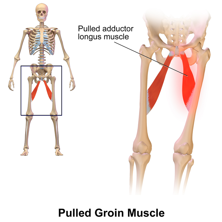 Pulled Groin Muscle